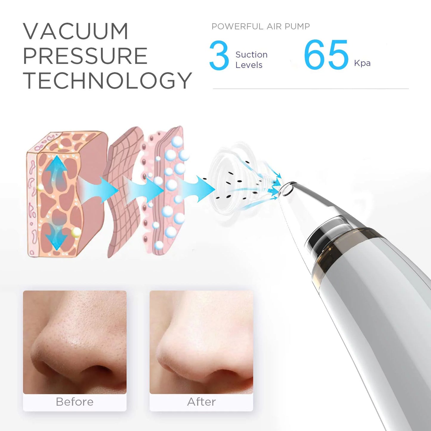 Blackhead Remover Pore Vacuum Cleaner Pimple Extractor - Facial Pore Cleaner Pore Extractor - Electric USB Pore Vacuum with 5 Probes - Blackhead Suction Tool - Blackhead Remover Kit (White)